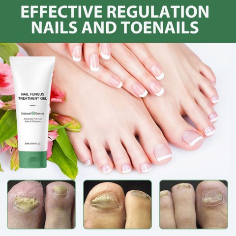 Nail Fungus Treatment Gel