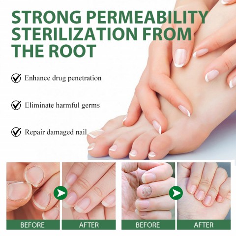 Nail Fungus Treatment Gel